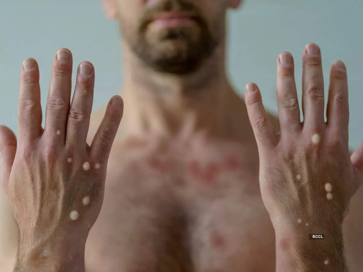 monkeypox